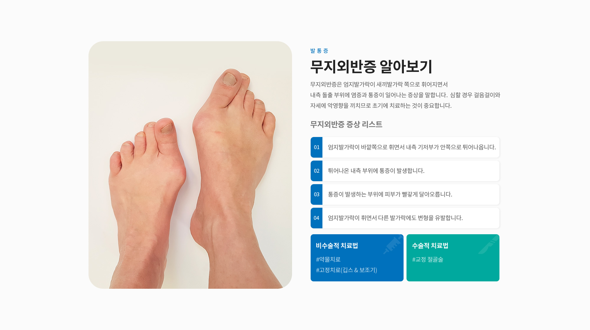 무지외반증